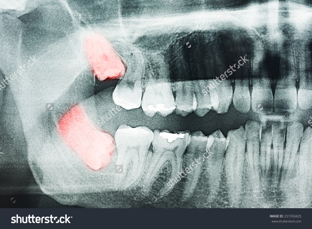 stock-photo-growing-wisdom-teeth-pain-on-x-ray-231350425 | Alvington House